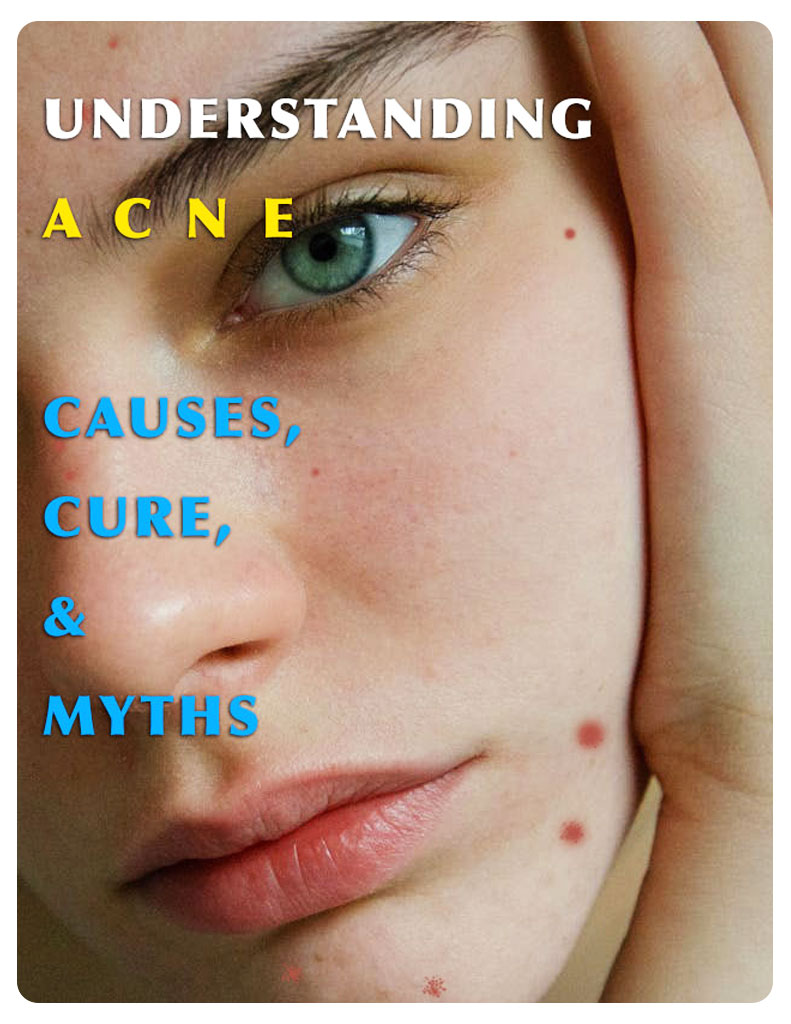 Understanding Acne, Causes, Cure & Myths